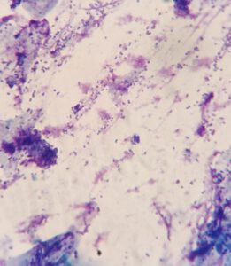 Oorsmeer met een mengbeeld van bacteriën en gisten bij oorontsteking